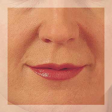 Smile Lines
