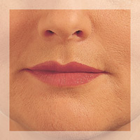 Lip Enhancement