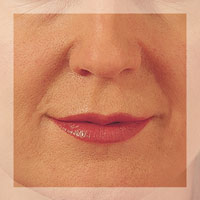 Smile Lines